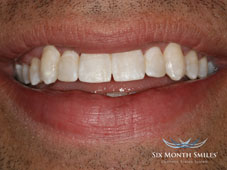 after straightening teeth